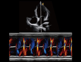 心尖四腔心， 彩色M模式