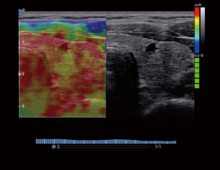 甲状腺，Elastography模式