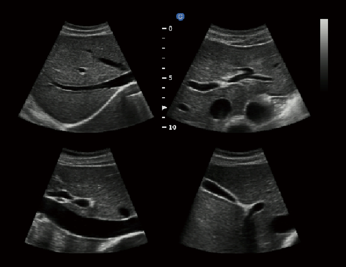 肝脏，B模式