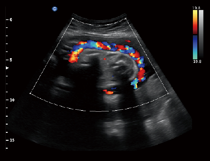 胎儿 脐带，C模式