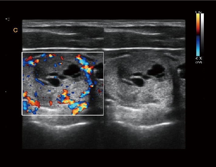 甲状腺结节，BC模式