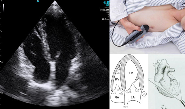 handheld ultrasound device