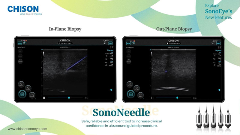 handheld ultrasound device