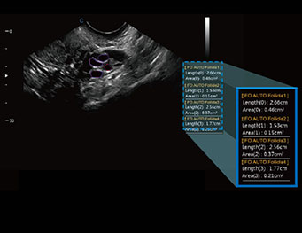 AutoFollicleDetection