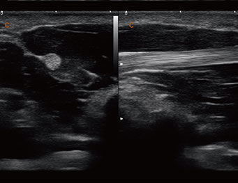 Primary flexor tendon , 2B Mode