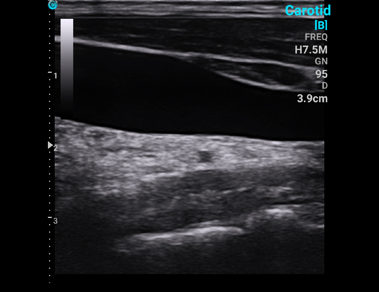 Internal-jugular, B Mode